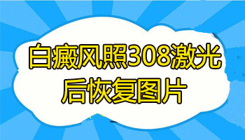 308准分子治疗优势有什么激光治疗多少钱