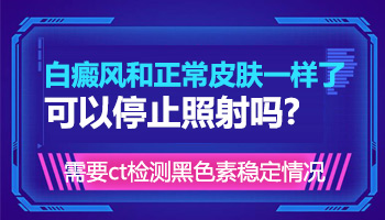 伍德灯下有白色反应说是白癜风靠谱吗