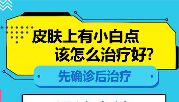 308激光治疗白癜风怎么收费