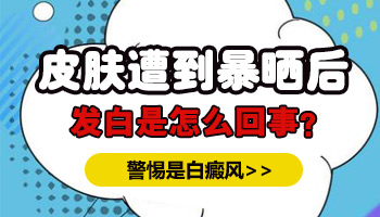 白癜风初期面积不大照准分子激光需要多少钱