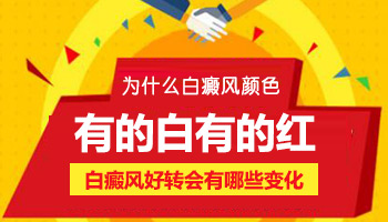 伍德氏灯检查能排除白斑是不是白癜风吗