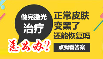 白斑照伍德灯亮白色说明是白癜风吗