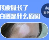 长在手上的白癜风要怎么治疗好点”