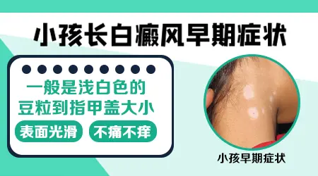 308准分子激光：儿童白癜风安全治疗的新选择