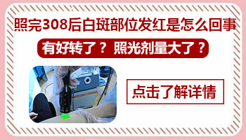 了解308光疗治疗小孩白癜风的大致费用