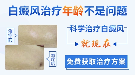 成年男性白癜风擦药一段时间后泛红是好转吗？