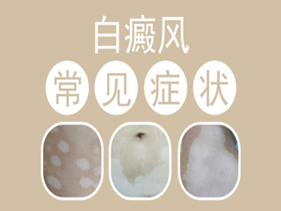 宝宝脖子白斑持续一月，是白癜风吗？