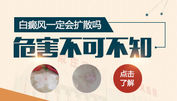 小面积发展期白癜风照308准分子激光多久能好