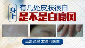 河北白癜风白斑白点图